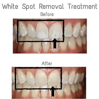 Brookline Smile Artists - White Spot Removal Treatment - General Dentistry Near Me - Brookline, Massachusetts