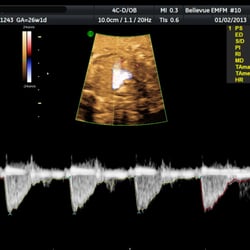 Eastside Maternal Fetal Medicine - Photo of my baby's heart beats.