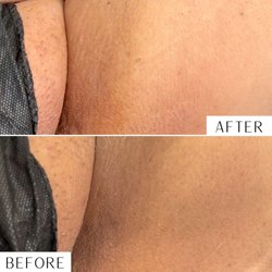 Melted Esthetic - One intimate bleaching treatment