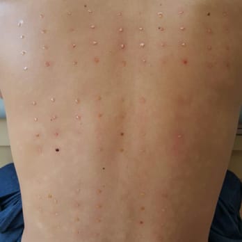 Aloha Allergy and Immunology - Multi-Prick Testing (Just put them on) - Allergists Near Me - Honolulu, Hawaii Aloha Allergy and Immunology - Multi-Prick Testing (Just put them on) - Allergists Near Me - Honolulu, Hawaii