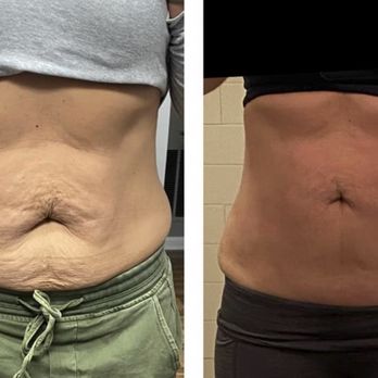 Cryo Contouring Studio - Cryotherapy Near Me - Bernardsville, New Jersey