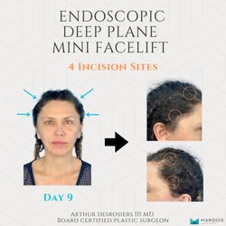 Marquis Plastic Surgery - Endoscopic Deep Plane Mini Facelift 4 Incision Results | Dr. Arthur Desrosiers