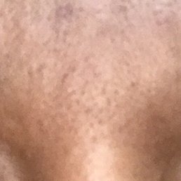 This is the finished project of my eyebrows . I'm never coming here again. As you can see I have no red pimples on my eyebrows.