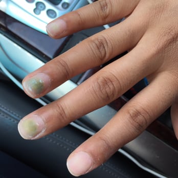 Bee Nails - Pseudomonas infection from reused acrylic or files. - Nail Salons Near Me - The Colony, Texas