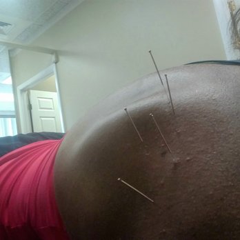 Michael A Selvitella, DC - Electrical acupuncture - Chiropractors Near Me - Streamwood, Illinois