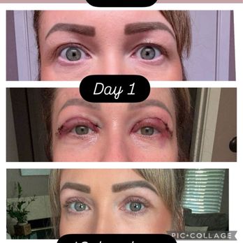 The Plastics Doc & Med Spa - Upper bleph surgery done on Aug 1 2025. - Plastic Surgeons Near Me - Corona, California The Plastics Doc & Med Spa - Upper bleph surgery done on Aug 1 2025. - Plastic Surgeons Near Me - Corona, California