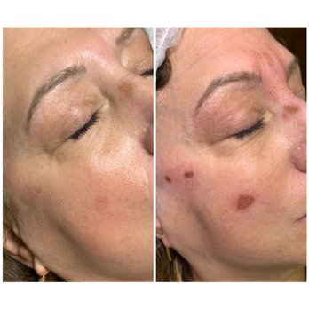Euphoria Esthetics - Sun Spot Removal - Skin Care Near Me - Sherrill, New York