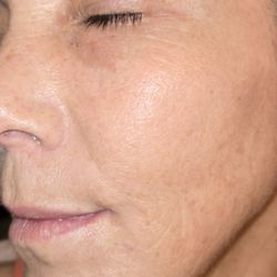 Deep wrinkles disappearing