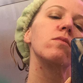 Elyssium Advanced Skin Care - Before first facial - Medical Spas Near Me - Oakland, California