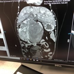 Noonan Chuck Dr - Mole's abdominal CT scan preop. Surgery removed that huge mass in the middle. He is fine  We cannot thank you enough   Janey Peterson.