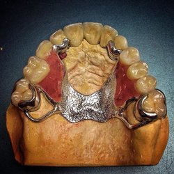 The Denture Group Clinic - Cast Partial Denture
