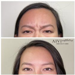 AIVI Aesthetics - Botox Frown Lines