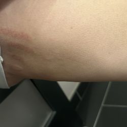 New Age Aesthetics & Wellness - Laser burn marks