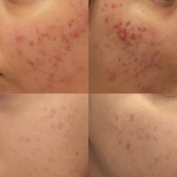 The Sacramento Esthetician - Two month progress!