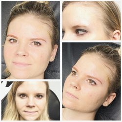 Premier Medspa - Before and After