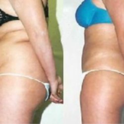 New Image Body and Face Contouring - Before and After: Female Waist