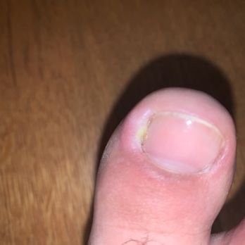 Coco Luxe Nails - Infected toe - Eyelash Service Near Me - Santa Monica, California Coco Luxe Nails - Infected toe - Eyelash Service Near Me - Santa Monica, California