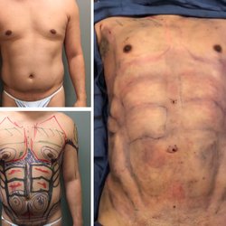 Norcal Liposculpture