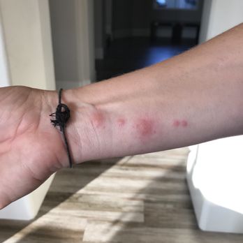 Redondo Pier Inn - Bed bug bites on my wrist - Hotels Near Me - Redondo Beach, California