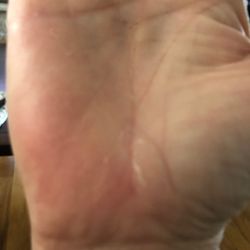 St Croix Dermatology - Right hand liz eggert just starting it is how left hand started???!!!!