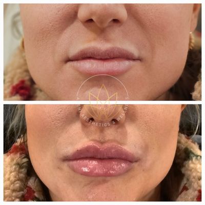 Tox/ Fillers/ Sculptra/ PRF EZ Gel - Before-and-after results from Tox, Dermal Filler, Sculptra treatments, and PRF EZ GEL showcasing natural enhancements and refreshed, balanced features.