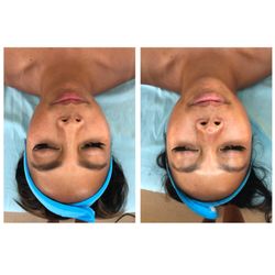 Saltwater and Skin - Brightening facial with a side of Dermabrasion