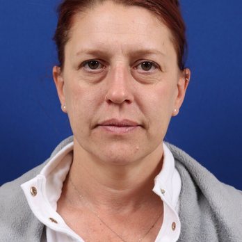Benjamin Bradford MD - Before picture 03/27/19 - Plastic Surgeons Near Me - Reno, Nevada Benjamin Bradford MD - Before picture 03/27/19 - Plastic Surgeons Near Me - Reno, Nevada