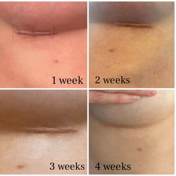 Sieber Plastic Surgery - 1 month results - Cosmetic Surgeons Near Me - San Francisco, California Sieber Plastic Surgery - 1 month results - Cosmetic Surgeons Near Me - San Francisco, California