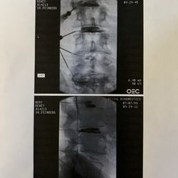 Santa Clara County Office of Veterans Services - July 7 1999 Discogram showed 5 annulus tears in 4 lower lumbar discs
