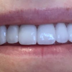Turlock Dentistry And Implants - New Smile, Happy Patient!!