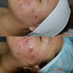 Skin Care by MJP - Post (3) LED Phototherapy treatments *still undergoing treatments