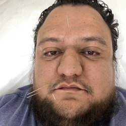 Hoa Da Acupuncture & Herb Center - Acupuncture for Bells Palsy