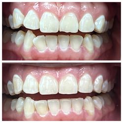 Family Smile Dental - Minor tooth correction, huge difference-Invisalign