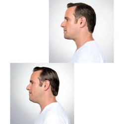 Aesthetic and Cosmetic Plastic Surgery Center - Kybella injection before & after on male