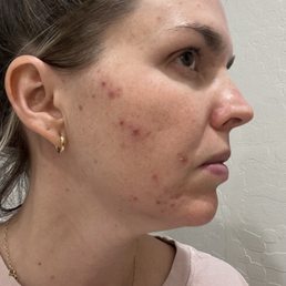 Pre treatment