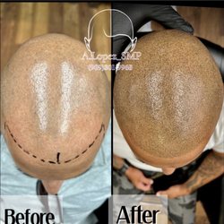Scalp micropigmentation - SMP hair procedure
