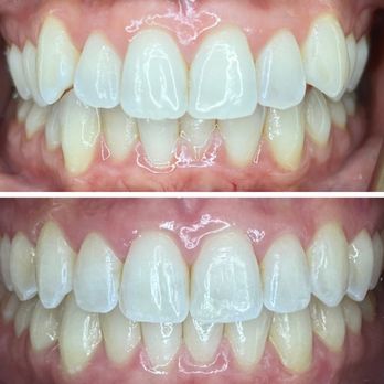 TLC Escondido Dental - Before and after invisalign treatment. - Oral Surgeons Near Me - Escondido, California TLC Escondido Dental - Before and after invisalign treatment. - Oral Surgeons Near Me - Escondido, California