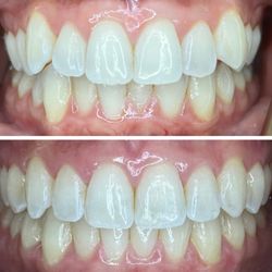 TLC Escondido Dental - Before and after invisalign treatment.