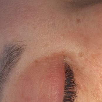 Rainbow Spa - Eye infection - Skin Care Near Me - Las Vegas, Nevada