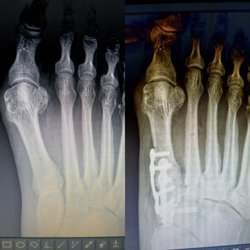 Seong M Yoo, DPM - Bunion correction, the right way