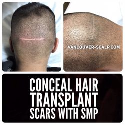 The Best 10 Hair Loss Centers Near Vancouver Scalp