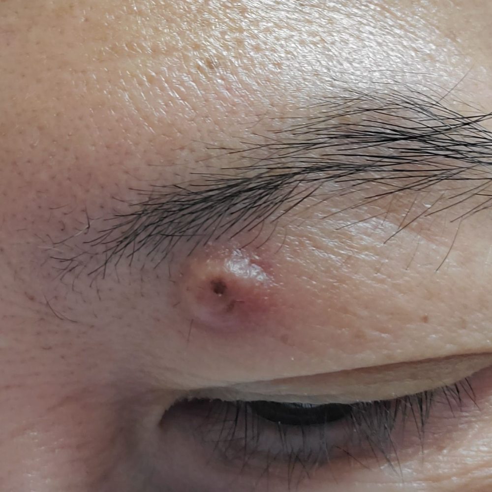 Adaniya Matthew S MD - Over the years that little "zit" grew on my eyebrow. It didn't really bother me until one day this bump had grown bigger & burst! - Cosmetic Surgeons Near Me - Honolulu, Hawaii Adaniya Matthew S MD - Over the years that little "zit" grew on my eyebrow. It didn't really bother me until one day this bump had grown bigger & burst! - Cosmetic Surgeons Near Me - Honolulu, Hawaii