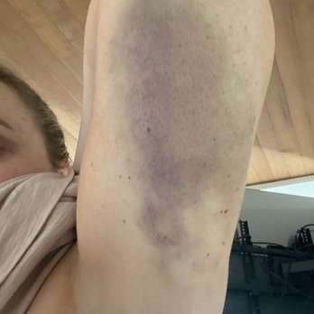 Mesa Spa - Bruised arms after massage - Massage Near Me - San Diego, California