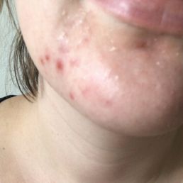 this was the most peeling I ever personally had, and this was my first peel. my skin was sooooo bad here!