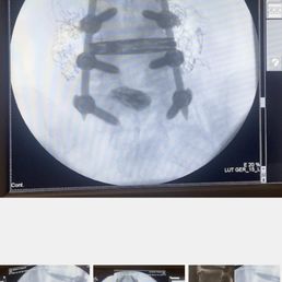 Dr. Kims surgery Floating disc Dr. Kims surgery Floating disc