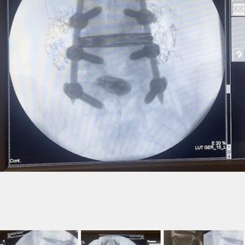 Choll Kim, MD PhD - Dr. Kims surgery Floating disc - Orthopedists Near Me - San Diego, California Choll Kim, MD PhD - Dr. Kims surgery Floating disc - Orthopedists Near Me - San Diego, California