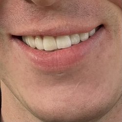 Tri-Star Denture & Dentistry - Crowns, Veneers work done a year ago. Thanks TriStar!