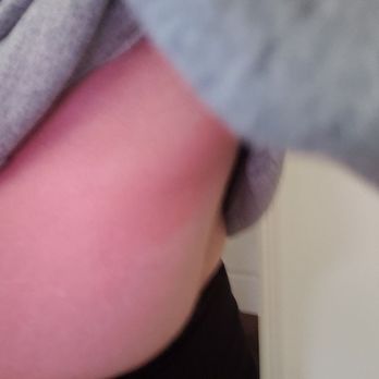 Whispering Sands Motel - Rash caused by the disinfectant that was admittedly sprayed on the bed - Hotels Near Me - Hanksville, Utah Whispering Sands Motel - Rash caused by the disinfectant that was admittedly sprayed on the bed - Hotels Near Me - Hanksville, Utah