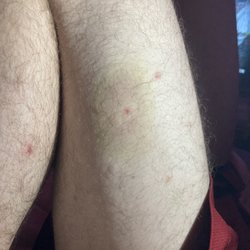 Turkey Creek Medical Center - Husband's bruised leg