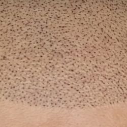 Scalp micro pigmentation by meechi - Scalp micro pigmentation texture
